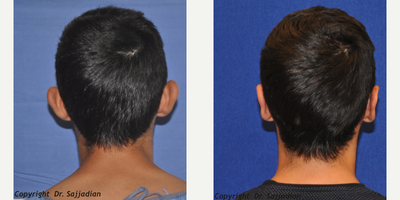 Ear Surgery - Ear Surgery