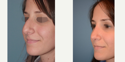 18-24 year old woman treated with Rhinoplasty & Sinus Surgery for a Deviated Septum - The patient felt her nose was too large and prominent, relative to her other facial features.  She was self conscious with the large bump, and the wide and droopy tip which worsened when she smiled.  She also could not breathe through her nose because of a deviated nasal septum and she suffered from chronic sinusitis.

This is a 24 year-old female who was very self conscious about her large nose, prominent bump, and wide droopy tip.  The nose seemed out of proportion and not balanced with her otherwise delicate facial features.  Additionally, she suffered from nasal obstruction and sinusitis.

A comprehensive exam revealed a prominent bump on the bridge of her nose, wide and strong tip cartilages, lack of tip support accentuating the droopy look when smiling, and a deviated septum.  The large nasal bump and the strong tip cartilages can be noted especially on the  view and side profile.

A closed approach was utilized to lower the bump on the bridge and replace it with a soft, gentle feminine slope, seen best on the  and side profile images.  The tip cartilages were made less bulbous and given a natural appearing definition.  Her deviated septum was fixed and she can now breathe much better.&nbsp;