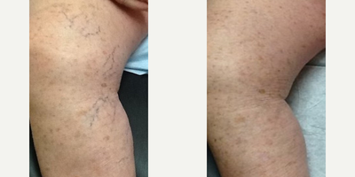 Asclera - Asclera  Leg Vein Treatment. Results 12 Weeks After 2nd Treatment After 4 Treatments