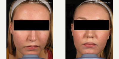 18-24 year old woman treated with Active FX - This 20 year old woman from the Los Angeles area suffered from cystic acne in her youth. After she successfully cleared up the acne break outs she was left with scarring primarily on her cheeks. The scarring was both evident in the texture of her skin as well as the tone. As you can see with this patient she had hyperpigmentation, redness as well as pitted scarring. She wanted a treatment which would finally give her a beautiful, healthy, even toned complexion. The Active FX CO2 laser is the most effective method to remove acne scars. The laser affects only 15% to 20% of the skin at a time, which allows for faster healing. Evident in her before and after photos the result is a smoothing out of the pitted texture of her skin, as well as evening out her complexion. This patient was left with the beautiful glowing skin she had always wanted.
