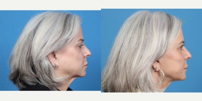 65-74 year old woman treated with Facelift - SMAS FACELIFT WITH PLATYSMALPLASTY AND FACIAL FAT GRAFT
