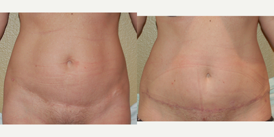 Tummy tuck revision with lipouction to flanks - The patient was seen at our Keller office. She had a tummy tuck with another surgeon a few years back. She was dissatisfied with her crooked scar. She had a tummy tuck revision at our Southlake Surgery Center.