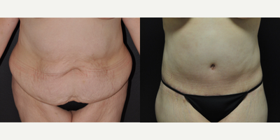 35-44 year old woman treated with Body Lift - 6 months after Belt Lipectomy (body lift), Liposuction of Abdomen, Flanks and Lower Back