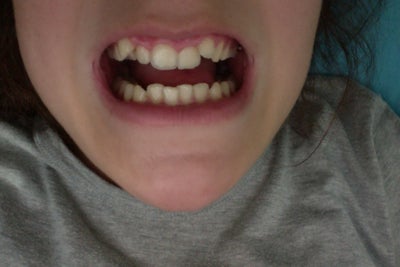 Do I need braces? My teeth are very crooked and crowded (Photo) Dentist ...