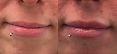 25-34 year old woman treated with Injectable Fillers for Lips - Treated with 1 syringe of Revanesse Versa for fuller lips and a more defined cupids bow.