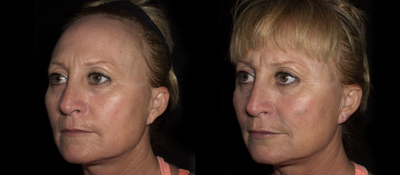 35-44 year old woman treated with Cheek Lift - Before and after filler injections for facial rejuvenation and contouring (liquid face lift)