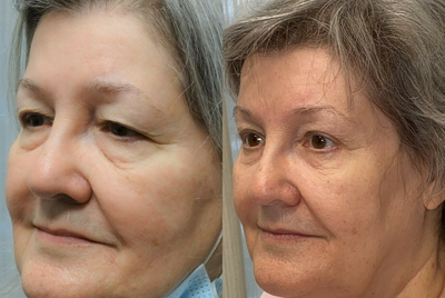 Woman treated with CO2 Laser - Endoscopic forehead and brow liftBlepharoplasty of both upper lidsTransconjunctival excision herniated orbital fat with CO2 laser skin resurfacing of both lower lids
