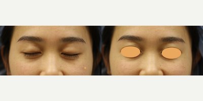 18-24 year old woman treated with Eyelid Surgery - 18-24 year old woman treated with an Asian Upper Eyelid Surgery (also known as an Upper Asian Blepharoplasty.)