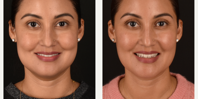 35-44 year old woman treated with Buccal Fat Removal, Chin Liposuction, Facial Fat Transfer, Mini Neck Lift - Deep Neck Liposuction and Lift, Buccal Fat Removal and Fat Harvest and Transfer to Chin, Mid-Face, Under-Eyes & Temples