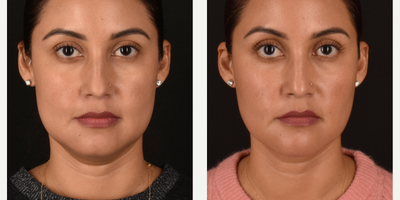 35-44 year old woman treated with Buccal Fat Removal, Chin Liposuction, Facial Fat Transfer, Mini Neck Lift - Deep Neck Liposuction and Lift, Buccal Fat Removal and Fat Harvest and Transfer to Chin, Mid-Face, Under-Eyes & Temples