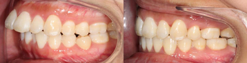 25-34 year old woman treated with Clear Braces - Treatment: 22 months of comprehensive orthodontics with extractions of upper first bicuspids and lower right second bicuspids for the treatment of excessive overjet and severe crowding.