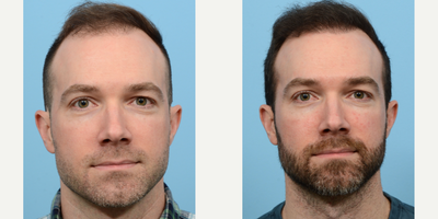 25-34 year old man treated with FUE Hair Transplant, Hair Transplant, Hair Loss Treatment, PRP for Hair Loss, NeoGraft - To strengthen this patient's receding hairline, Dr. Wise transplanted 3,050 grafts during an FUE hair transplant. Additionally, the patient received a treatment of PRP to strengthen the follicles.