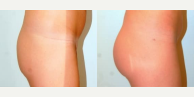 Woman treated with Butt Implants - Woman treated with Butt Implants