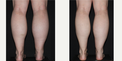 45-54 year old woman treated with Calf Reduction - Gastrocnemius muscle hypertrophy before and 6 months after Botox injection for calf muscle reduction by more than 2 cm.