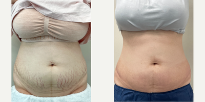 25-34 year old woman treated with Halo Laser - HALO laser for the treatment of stretch marks performed at 8 West Clinic, Vancouver, BC