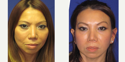 Mid Facelift - This female sought Mid Facelift (Cheek Lift) to correct sagging of the cheek and mid face.  She was also unhappy with the flattened appearance of her cheek.  The features gave the patient a tired appearance.  The patient sought surgery that would help her appearance more youthful and refreshed.  Following Mid Facelift, notice the elevation of the cheek and upper face.   Also, notice the improved prominence and youthful fullness which was restored to the cheek and upper face.