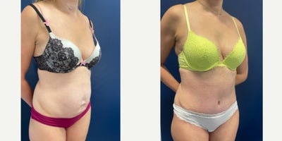 35-44 year old woman treated with Tummy Tuck, Liposuction, Power-Assisted Liposuction (PAL), Abdominal Etching, Umbilical Hernia - This beautiful mom of two underwent Tummy tuck with Liposuction, as well as Diastasis Recti Repair to create a flatter and more defined abdominal contour.  Her umbilical hernia was repaired and reconstructed at the same time creating a small innie belly button with minimal scarring on the outside.The scars will continue to fade over time.
