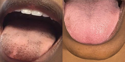 25-34 year old woman treated with Laser Peel - 25 year old woman treated with Ruby Laser for tongue pigmentation. Image shows 4 weeks after the 2nd Ruby Laser treatment.