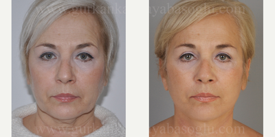 65-74  year old woman treated with Facelift Revision - Dr.Kayabasoglu is the only triple board-certified facial plastic surgeon all around Europe. He is not performing any surgeries other than facial surgeries. So that, these pictures are from his deep plane facelift surgeries due to the fact that no revision was required in his facelift operations up to this time.
