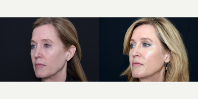 Woman treated with Bellafill - Woman treated with Bellafill