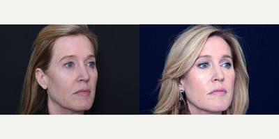 Woman treated with Bellafill - Woman treated with Bellafill