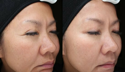 Woman treated with VI Peel - Woman treated with VI Peel