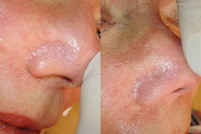 Before and After Veingogh Thermolysis for Spider Veins of the Face - 	Before and after photo of a patient with face / nose veins who underwent Ohmic thermolysis of the veins. This form of technology to treat spider veins of the face or legs is known as Veingogh or Veinwave treatment.