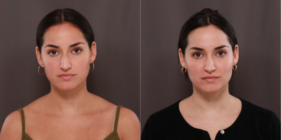 25-34 year old woman treated with Rhinoplasty, Restylane Refyne - Rhinoplasty to improve dorsal hump, overall size, and thickness of nose