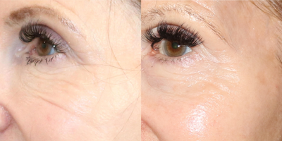 65-74 year old woman treated with Potenza - 71 year old female with deep crows feet and under eye lines. Has tried various treatments and is seeing great improvement with Potenza Radiofrequency Microneedling with PRP. After photo taken 1 month post 3rd treatment.