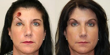 Mohs Surgery Scar On Nose Doctor Answers Tips Mohs Surgery Scar On Nose Doctor Answers Tips