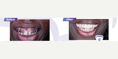 25-34 year old woman treated with All-on-4 Dental Implants - Upper all-on-6, with bottom teeth whitening.