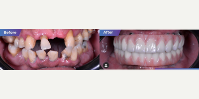 55-64 year old man treated with All-on-4 Dental Implants - Upper and bottom Zirconia all-on-6