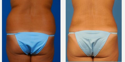 35-44 year old woman treated with Liposuction - Waistline fatty deposits resistant to diet and exercise