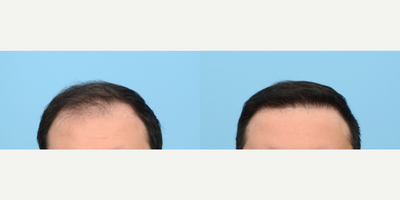 25-34 year old man treated with Hair Transplant, Hair Loss Treatment, PRP for Hair Loss, FUE Hair Transplant, NeoGraft - To fortify the patient's hairline and crown area, Dr. Wise performed an FUE hair transplant with 3,030 grafts and one treatment of PRP. 6 months post-op the patient's results look great and he is excited to see more progress up to 1 year mark.