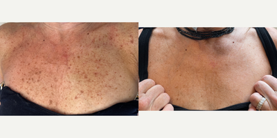 55-64 year old woman treated with BroadBand Light (BBL), Moxi - Before and after 1 session of BBL & Moxi