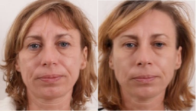 Woman treated with Exilis - Woman treated with Exilis