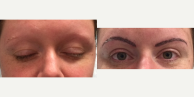 35-44 year old woman treated with Permanent Makeup - Patient came to us with very sparse eyebrows with the desire to have a more fuller appearance.