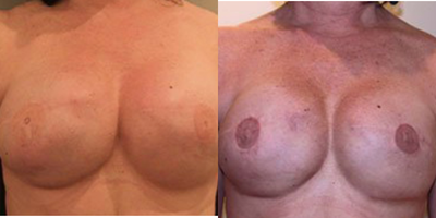 35-44 year old woman treated with Breast Reconstruction - Breast Reconstruction patient improves outcome and is pain free after second surgery our patient underwent a mastectomy and breast reconstruction with another practice. She was not happy with appearance and feel of breast postoperatively. This patient was also experiencing pain likely from implants which were too large for her frame. She sought out a doctor for breast implant revision surgery. Our patient is a full time working mother in her early 40's. She is 5' 4