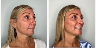 45-54 year old woman treated with Restylane Contour - Cheek enhancement