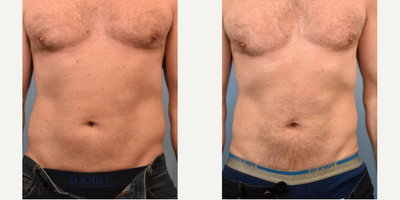 Man treated with CoolSculpting - Man treated with CoolSculpting.