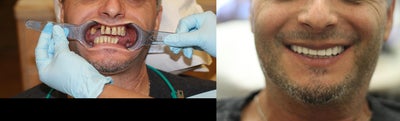 All-on-4 Dental Implants - Tooth loss, gum disease and bone disease affect millions of people worldwide, on every continent, in every age group. Globally, several hundred million people are thought to be missing one or more teeth. More than 40 million people are estimated to be fully edentulous in the United States alone. Completely edentulous jaws (no teeth) are a much more widespread handicap than most of us realize. Major barriers for solving the problem are the perceived complexity, stagnant technology and high cost of treatment. With innovative new solutions this no longer needs to be the case.&nbsp;
