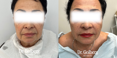 65-74 year old woman treated with Thread Lift - Non-surgical face rejuvenation using the Dr. G Lift procedure is not limited by age, as it combines PDO threads and bio-stimulating agents to achieve outstanding and natural-looking results that endure over time. This innovative treatment technique offers patients an opportunity to achieve facial rejuvenation without the need for surgery.