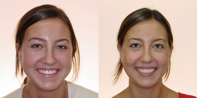 Treated with Damon Braces after two orthodontists said surgery would be required. - This was a highly motivated girl who wanted treatment to be as fast as possible.  Excellent rubber band wearer.  Two other orthodontists said that she had to have surgery to be treated.  She finished in 1 year 3 months.