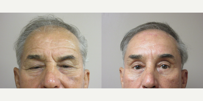 Upper Eyelid Surgery with Browlift - Patient felt his heavy eyelids made him look older and tired.  Dr. Eric Schaffer performed an upper eyelid blepharoplasty  and a browlift which give him a much improved appearance.