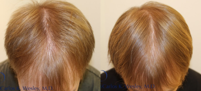 25-34 year old man treated with PRP for Hair Loss - Patient treated with PRP for Hair loss