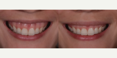 25-34 year old woman treated with Gum Lift - The gummy smile may be seen when the upper lip goes too far upon smiling, resulting in an unpleasant facial expression. The patient was subjected to an innovative treatment called lip repositioning.