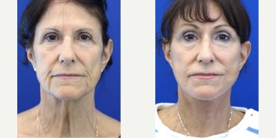 65-74 year old woman treated with Facelift Revision, Brow Lift - This ladys facial rejuvenation journey turns back the hands of time. Initial procedures years ago have left her with unnatural neck muscle banding. Revision forehead and facelift constitute a full facial tissue reposition.