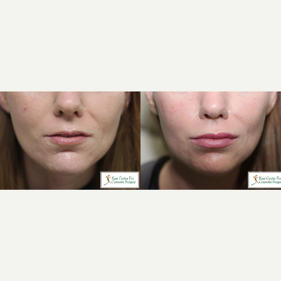 25-34 year old woman treated with Silikon 1000 - This young woman was tired and frustrated that the fillers used for Lip Augmentation went away so quickly.  She complained that the fillers never lasted as long as advertised.  Here she is when she returned to see us after having just a single treatment of permanent Silikon 1000.  Like many patients, she was delighted with her results but requested additional treatment.