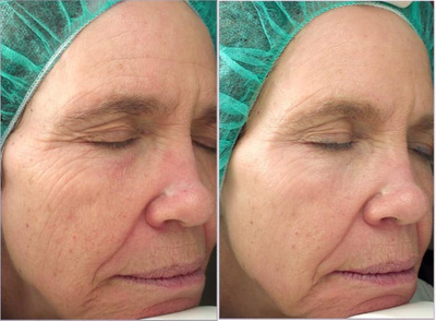 Woman treated with Vivace - Woman treated with Vivace