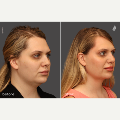 Submental Liposuction - 27 yo female who is 3 months out from submental liposuction performed in the office under local anesthetic